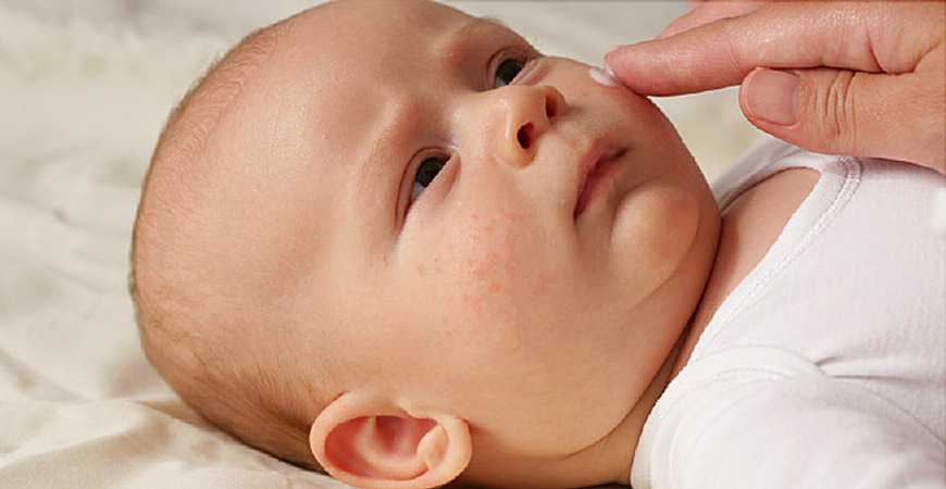 حساسیت ها و مراقبت از پوست نوزاد